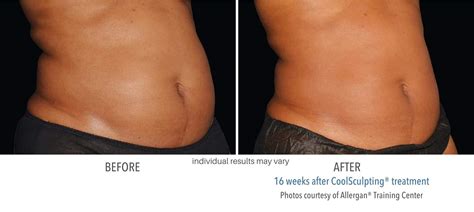 laseraway coolsculpting reviews